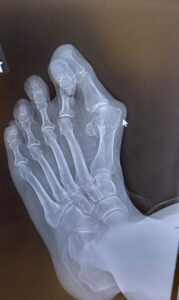 Xray of foot for The Big 65 Medicare Senior Insurance Services company.