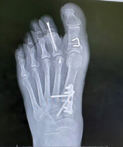 X-ray of foot after successful bone surgery.